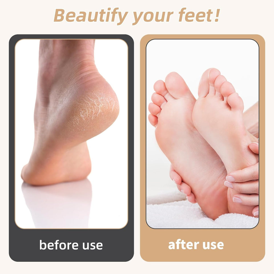 Electric Callus Remover